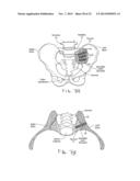 FENESTRATED IMPLANT diagram and image