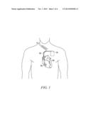 COMBINED REMODELING CONTROL THERAPY AND ANTI-REMODELING THERAPY BY     IMPLANTABLE CARDIAC DEVICE diagram and image