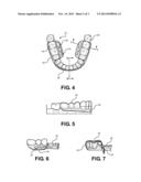 Method and Oral Appliance for Improving Air Intake and Reducing Bruxism diagram and image