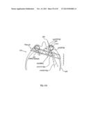 ORTHOVOLTAGE RADIOTHERAPY diagram and image