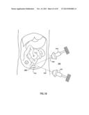 ORTHOVOLTAGE RADIOTHERAPY diagram and image