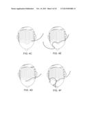 SOFT TISSUE AUGMENTATION THREADS AND METHODS OF USE THEREOF diagram and image