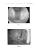 BLOOD VESSEL GRAFTS FOR REPAIR, RECONSTRUCTION AND FILLER MATERIALS diagram and image