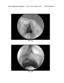 BLOOD VESSEL GRAFTS FOR REPAIR, RECONSTRUCTION AND FILLER MATERIALS diagram and image