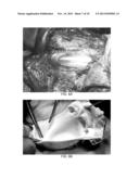 BLOOD VESSEL GRAFTS FOR REPAIR, RECONSTRUCTION AND FILLER MATERIALS diagram and image