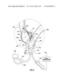 CAROTID BODY MODULATION PLANNING AND ASSESSMENT diagram and image