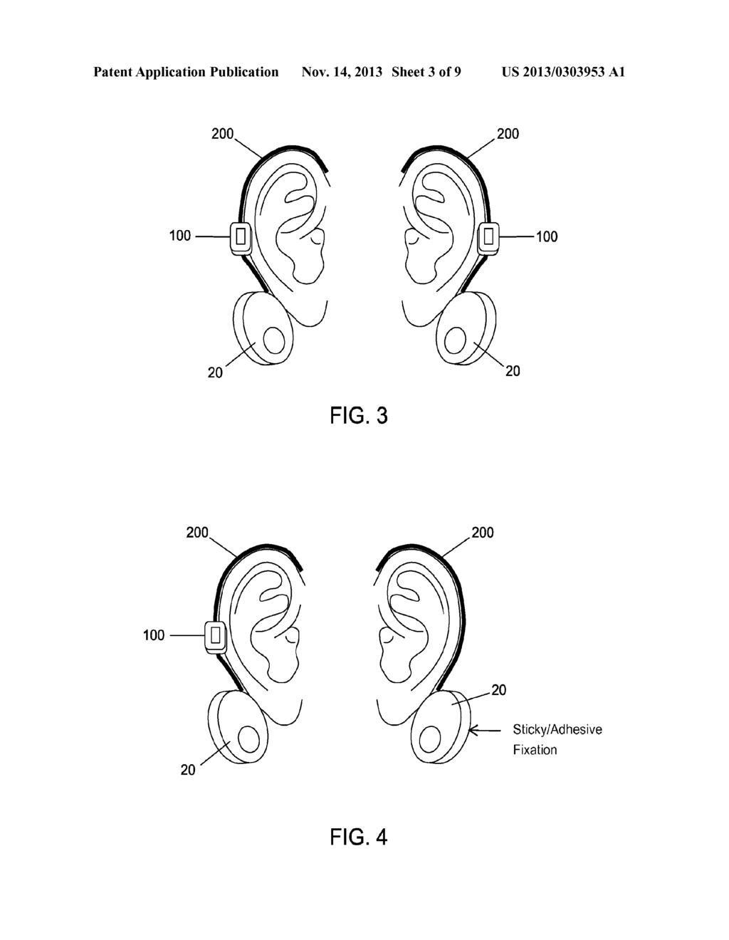 METHOD AND APPARATUS FOR TREATING VARIOUS NEUROLOGICAL CONDITIONS - diagram, schematic, and image 04