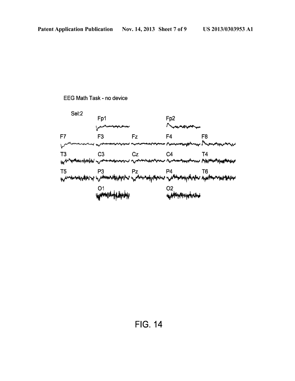 METHOD AND APPARATUS FOR TREATING VARIOUS NEUROLOGICAL CONDITIONS - diagram, schematic, and image 08