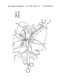 SYSTEM AND METHOD FOR TREATMENT OF NON-VENTILATING MIDDLE EAR BY PROVIDING     A GAS PATHWAY THROUGH THE NASOPHARYNX diagram and image