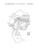 SYSTEM AND METHOD FOR TREATMENT OF NON-VENTILATING MIDDLE EAR BY PROVIDING     A GAS PATHWAY THROUGH THE NASOPHARYNX diagram and image