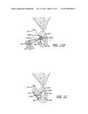 SYSTEM AND METHOD FOR TREATMENT OF NON-VENTILATING MIDDLE EAR BY PROVIDING     A GAS PATHWAY THROUGH THE NASOPHARYNX diagram and image