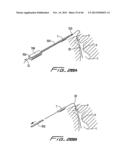 DIALYSIS CATHETER diagram and image