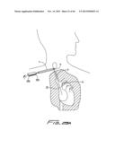 DIALYSIS CATHETER diagram and image