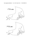 DIALYSIS CATHETER diagram and image