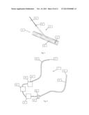 SYSTEMS AND METHODS FOR REMOVING UNDESIRABLE MATERIAL WITHIN A CIRCULATON     SYSTEM UTILIZING A BALLOON CATHETER diagram and image