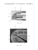 APPLICATOR INSTRUMENTS HAVING DISTAL END CAPS FOR FACILITATING THE     ACCURATE PLACEMENT OF SURGICAL FASTENERS DURING OPEN REPAIR PROCEDURES diagram and image