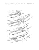 DEVICE AND METHOD FOR ANASTOMOSIS diagram and image