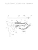 DEVICE AND METHOD FOR ANASTOMOSIS diagram and image