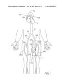 SYSTEMS AND APPARATUS FOR TREATING BLOOD VESSELS AND RELATED METHODS diagram and image