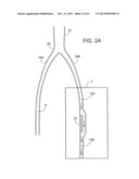 SYSTEMS AND APPARATUS FOR TREATING BLOOD VESSELS AND RELATED METHODS diagram and image