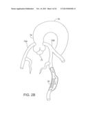 SYSTEMS AND APPARATUS FOR TREATING BLOOD VESSELS AND RELATED METHODS diagram and image