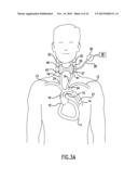 ANTI-EMBOLIC DEVICE AND METHOD diagram and image