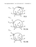 ANTI-EMBOLIC DEVICE AND METHOD diagram and image