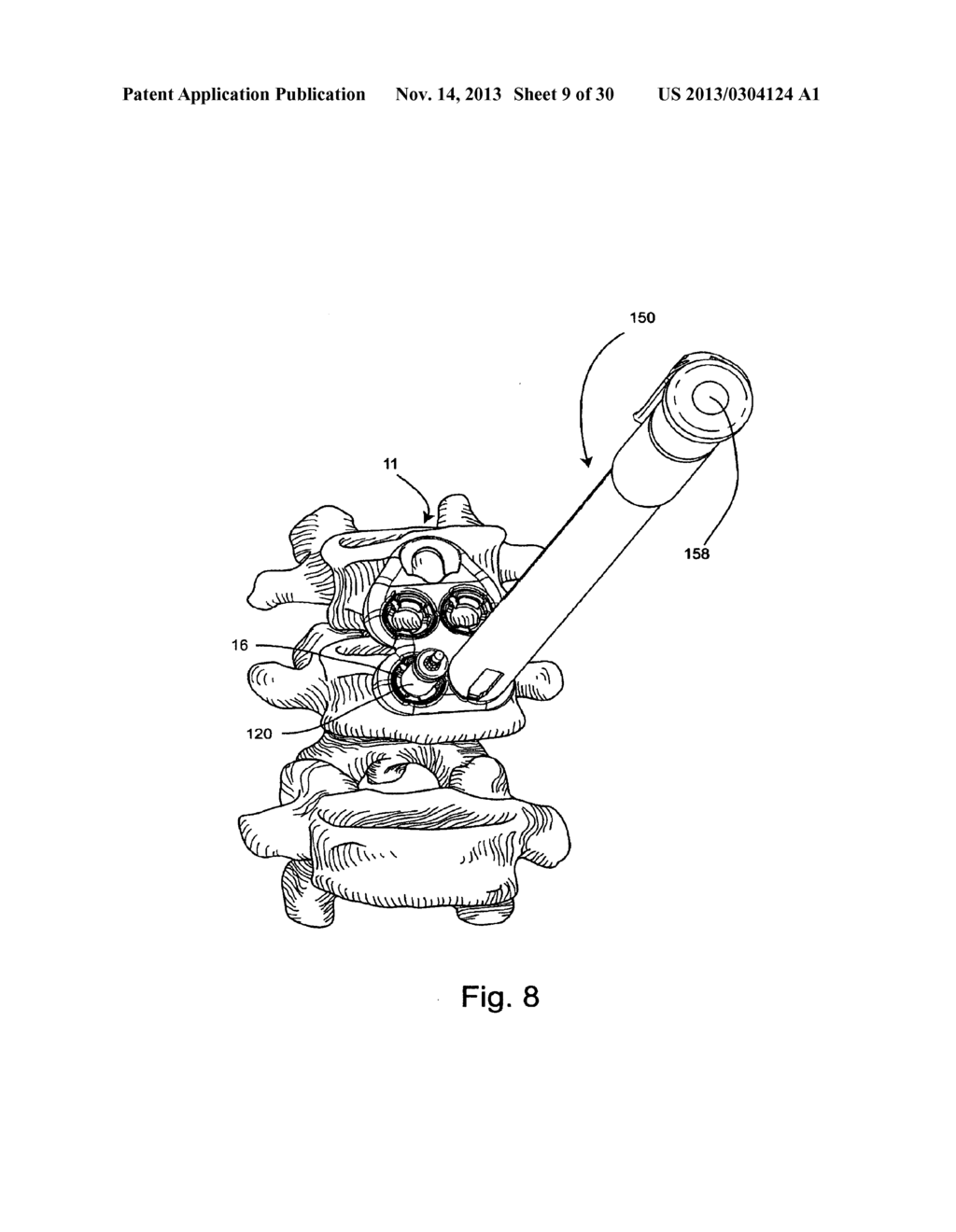 SYSTEM AND METHOD FOR VERTEBRAL BODY PLATING - diagram, schematic, and image 10