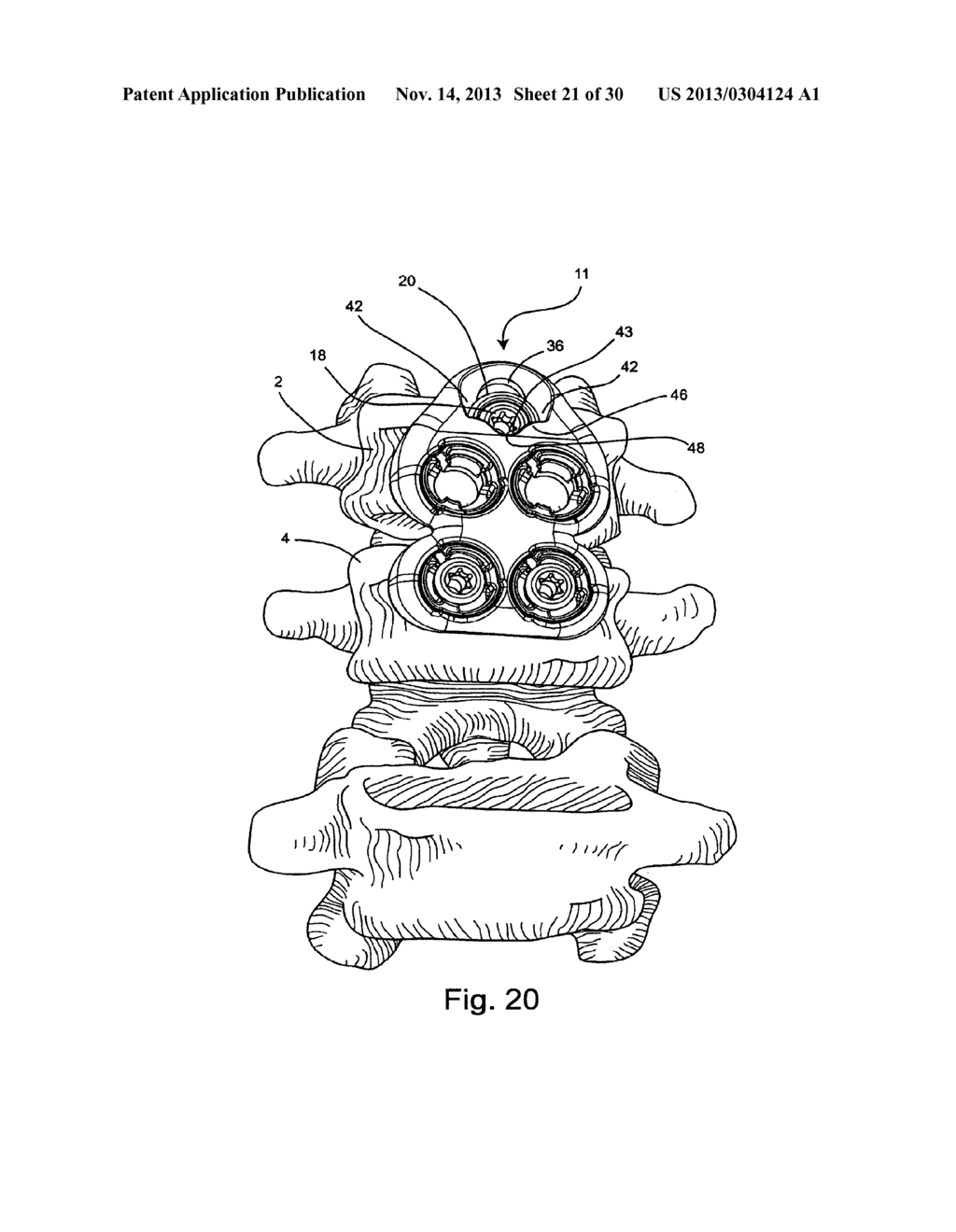 SYSTEM AND METHOD FOR VERTEBRAL BODY PLATING - diagram, schematic, and image 22