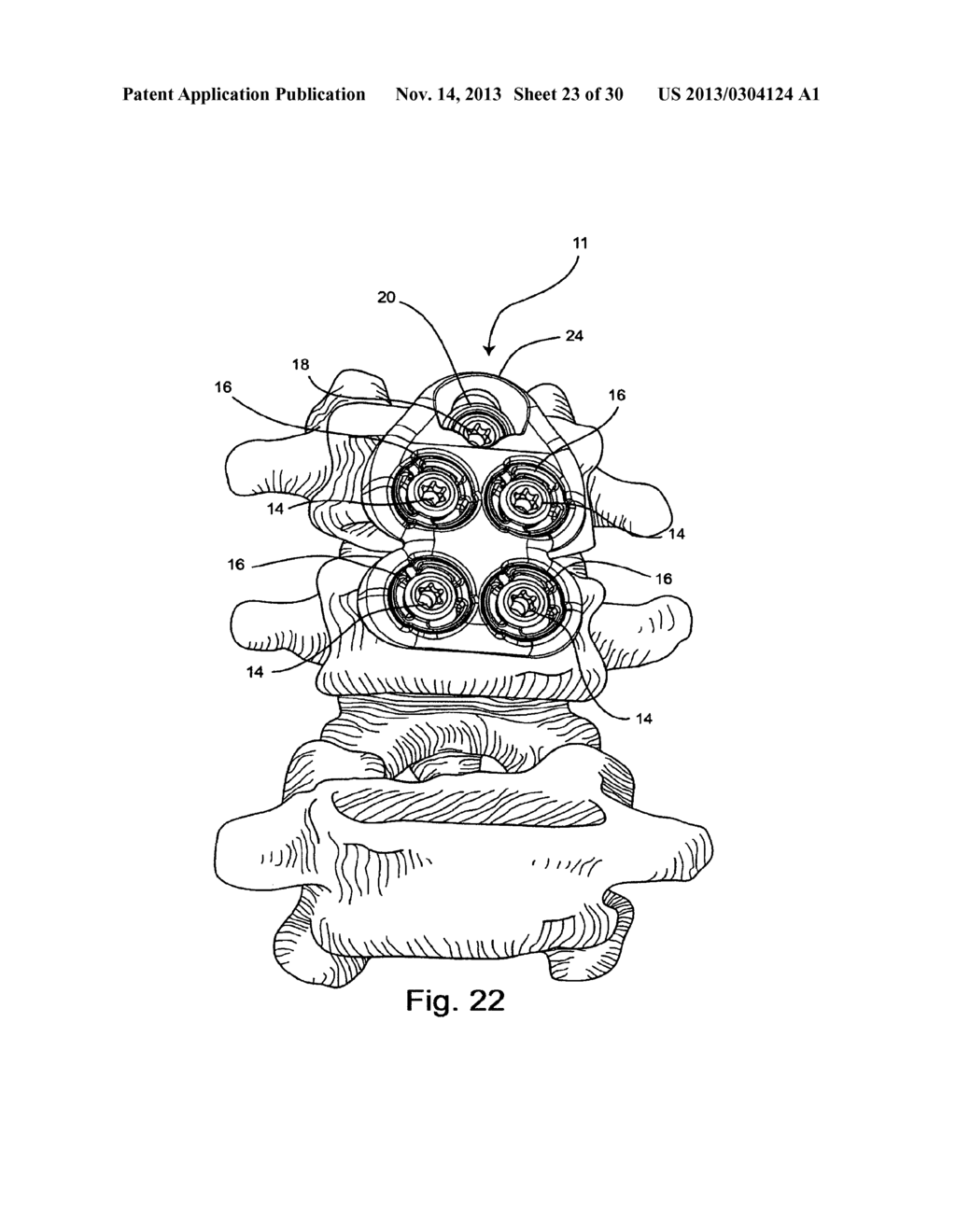 SYSTEM AND METHOD FOR VERTEBRAL BODY PLATING - diagram, schematic, and image 24