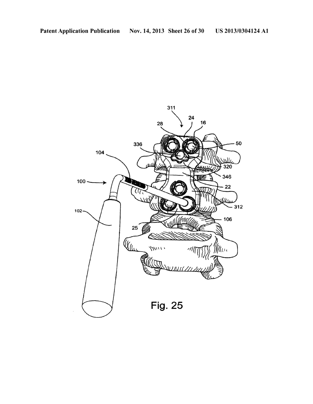 SYSTEM AND METHOD FOR VERTEBRAL BODY PLATING - diagram, schematic, and image 27