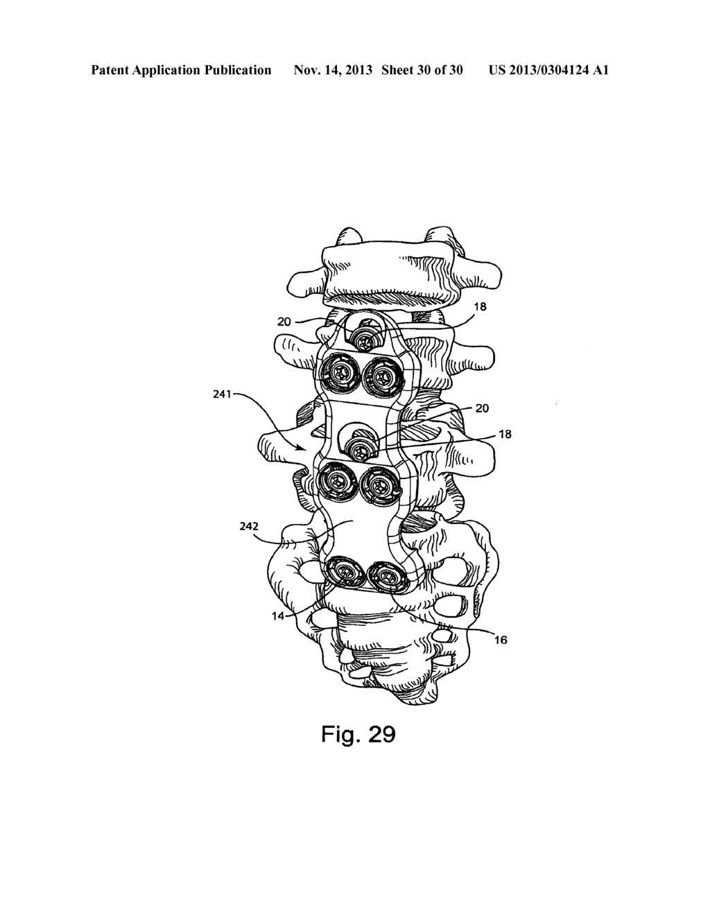 SYSTEM AND METHOD FOR VERTEBRAL BODY PLATING - diagram, schematic, and image 31