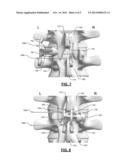 INTERSPINOUS PROCESS DEVICE AND METHOD diagram and image