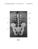 ILIAC CONNECTOR, CONNECTOR HEAD, SPINAL FIXATION SYSTEM AND METHOD OF     STABILIZING A SPINE diagram and image