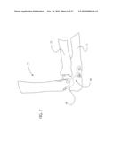 INTERNAL JOINT STABILIZER DEVICE, SYSTEM AND METHOD OF USE diagram and image