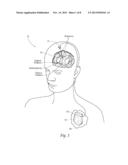 NON-REGULAR ELECTRICAL STIMULATION PATTERNS FOR TREATING NEUROLOGICAL     DISORDERS diagram and image