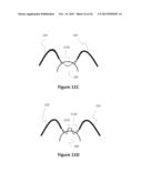 Accommodative-Disaccommodative intraocular Lens diagram and image