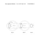 Intraocular Device to Restore Natural Capsular Tension after Cataract     Surgery diagram and image