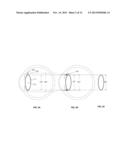 Intraocular Device to Restore Natural Capsular Tension after Cataract     Surgery diagram and image