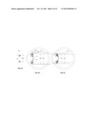 Intraocular Device to Restore Natural Capsular Tension after Cataract     Surgery diagram and image