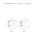 Intraocular Device to Restore Natural Capsular Tension after Cataract     Surgery diagram and image