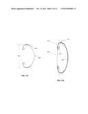 Intraocular Device to Restore Natural Capsular Tension after Cataract     Surgery diagram and image