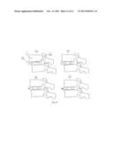 INTERVERTEBRAL MEDICAL IMPLANT diagram and image