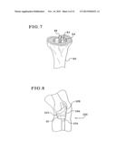 TIBIAL AUGMENTS FOR USE WITH KNEE JOINT PROSTHESES, METHOD OF IMPLANTING     THE TIBIAL AUGMENT, AND ASSOCIATED TOOLS diagram and image