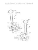 TIBIAL AUGMENTS FOR USE WITH KNEE JOINT PROSTHESES, METHOD OF IMPLANTING     THE TIBIAL AUGMENT, AND ASSOCIATED TOOLS diagram and image