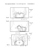 Customization of a Dose Distribution Setting for a Technical Appliance for     Tumour Therapy diagram and image