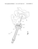 PERIPHERAL PEG DRILL COMPONENT diagram and image