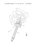 PERIPHERAL PEG DRILL COMPONENT diagram and image