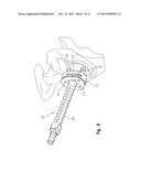 PERIPHERAL PEG DRILL COMPONENT diagram and image