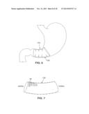 SATIATION DEVICES AND METHODS diagram and image